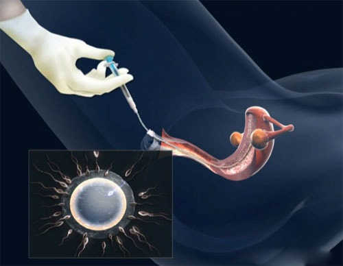 bơm tinh trùng vào buồng tử cung